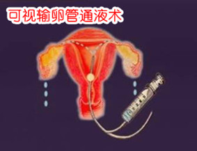女性输卵管堵塞可视通液图片