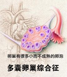 女性得了多囊卵巢综合症怎么治疗好