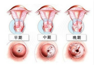 女性得了宫颈糜烂的症状图片