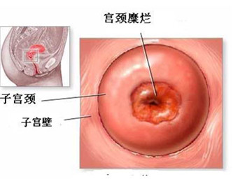 专家提醒 宫颈糜烂治疗要逃离五大误区