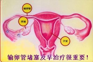 输卵管堵塞的治疗方法