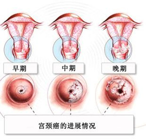 轻度宫颈糜烂怎么办