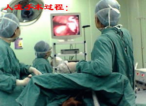 无痛人流手术过程图''